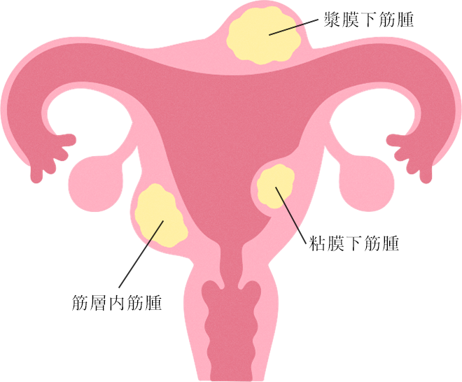 子宮筋腫の種類の画像